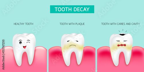 Step of tooth decay formation. Healthy tooth, forming dental plaque and finally caries and cavity. Cute cartoon design, illustration isolated on green background. Dental care concept.