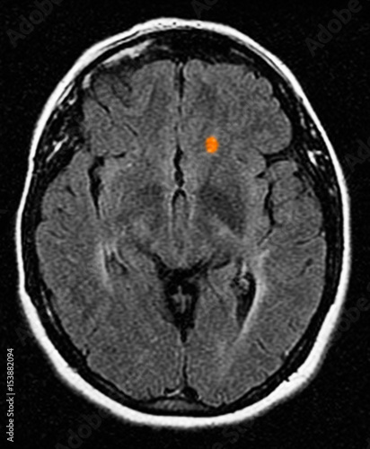 MRI of multiple sclerosis in a 42 year old woman