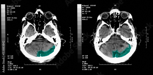 CT scan of elderly man with old occipital infarct photo