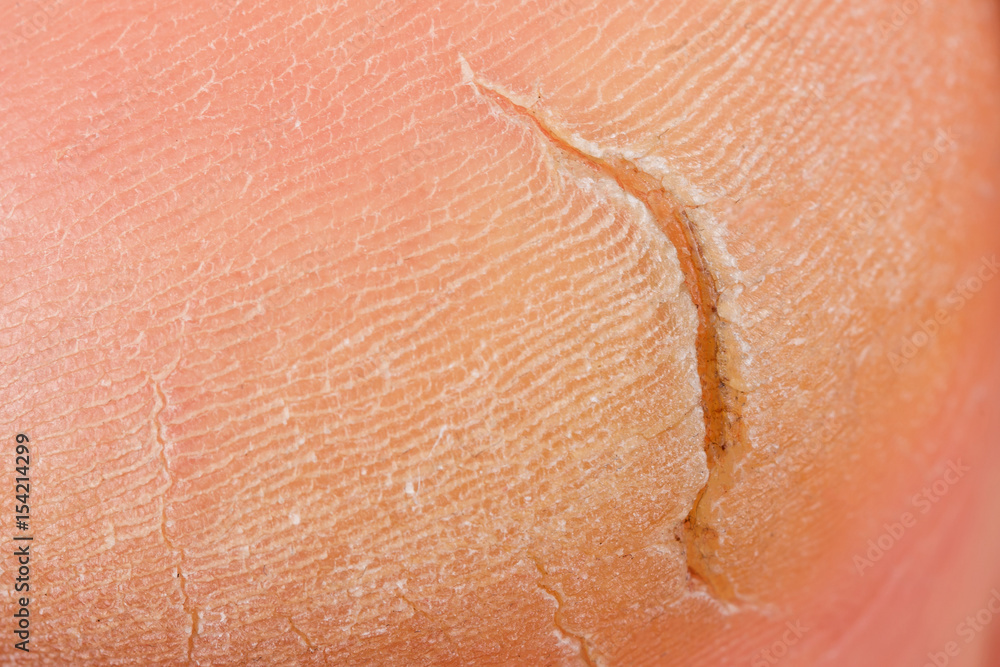 Fototapeta premium Cracked dry human heel close up