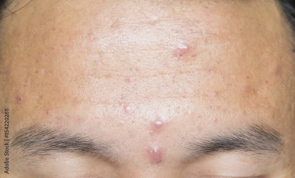 Obraz premium Acne head on the forehead.