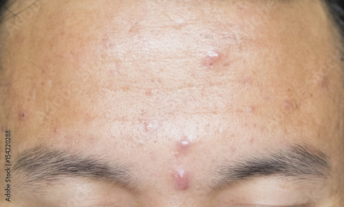 Acne head on the forehead.