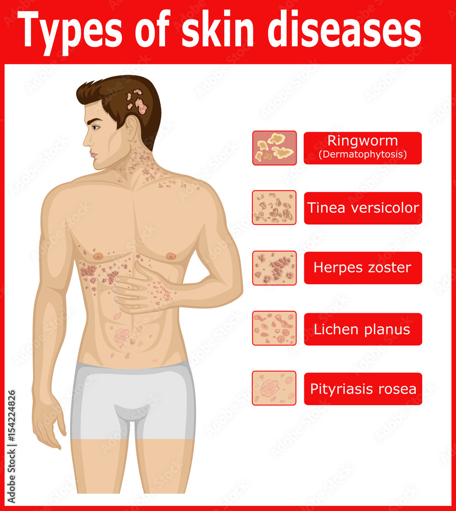 all type of skin diseases