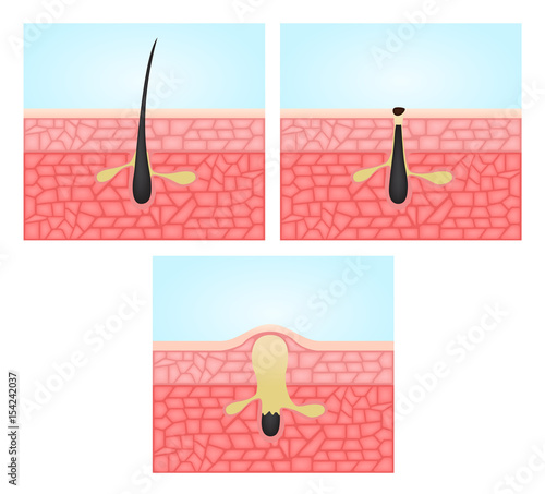 acne and skin vector