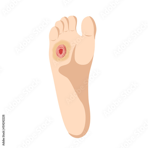 Callus Ischemic and neuropathic Diabetic Foot skin
