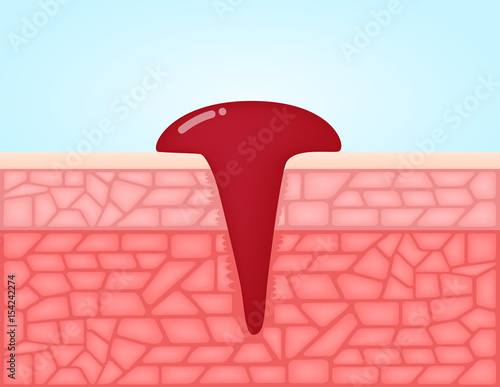 wound skin vector graphic . the blood come out of it , bleeding