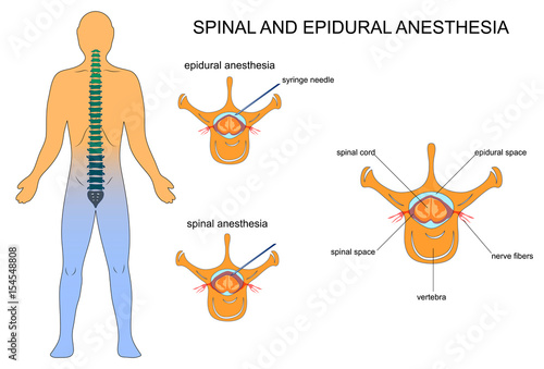 epidural and spinal anaesthesia photo