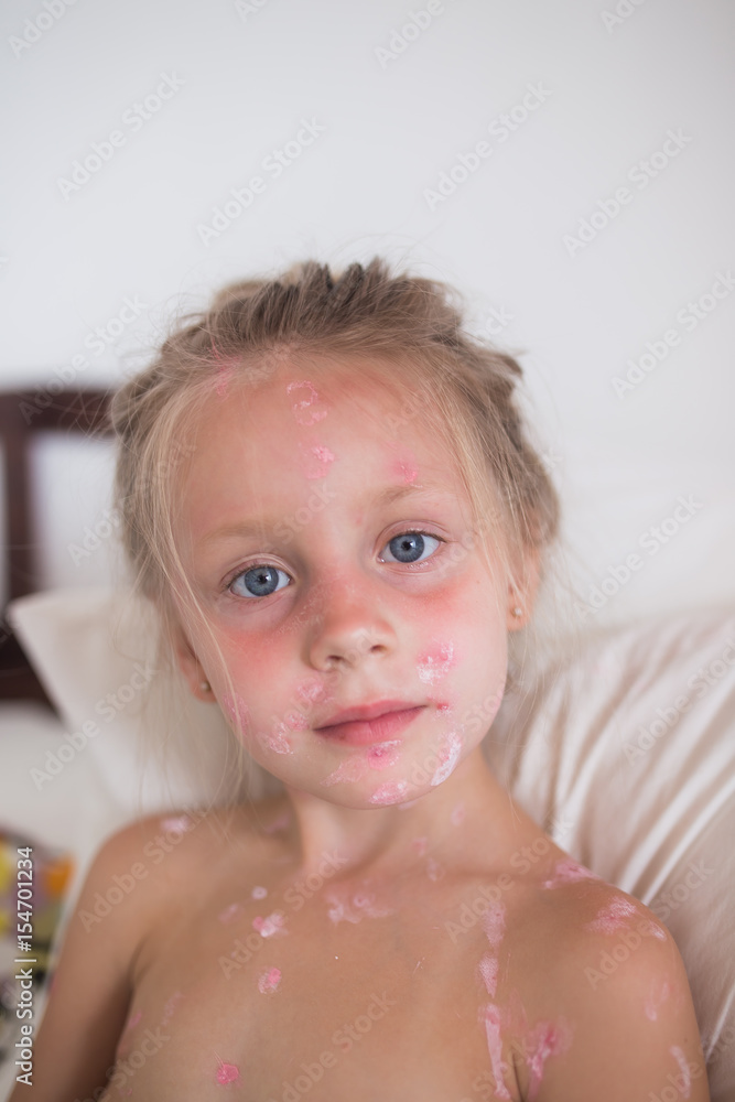 The cute little girl is sick with chickenpox. The face is covered with pimples. The cute little girl is sick with chickenpox. The face is covered with pimples.