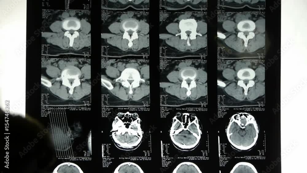 Doctors study skull brain X-ray film for analysis.cerebellum,brainstem. Doctors study skull brain X-ray film for analysis.cerebellum,brainstem.