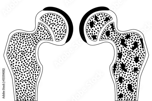 Hip bone healthy and with osteoporosis vector eps 10