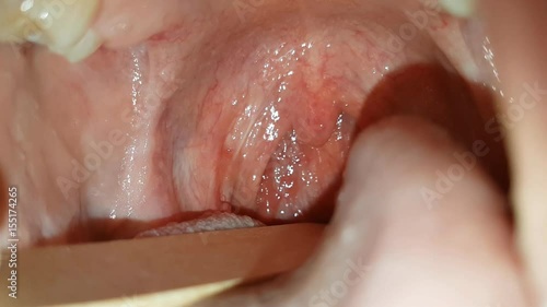 cavo orale femminile a seguito di intervento di tonsillectomia photo