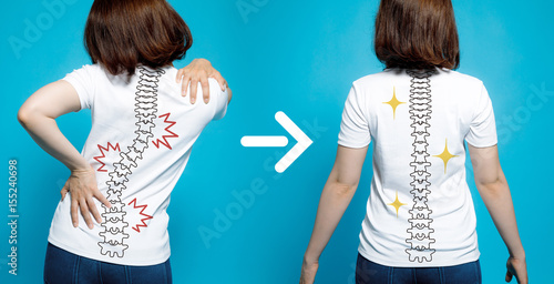 chiropractic before after image. from bad posture to good posture. woman's body and backbone. photo