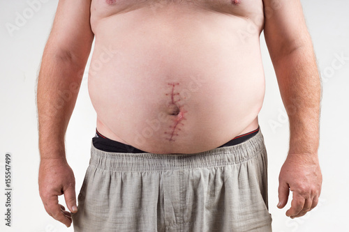 A scar on the big man's stomach