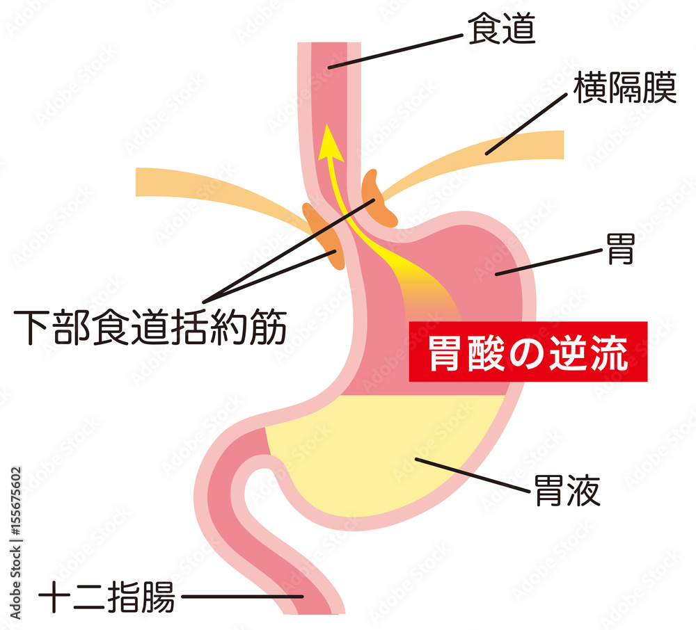 胃酸の逆流 逆流性食道炎 Stock イラスト Adobe Stock