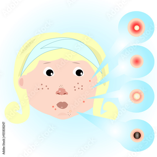 girl with acne problems
