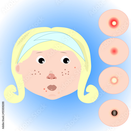 girl with acne problems