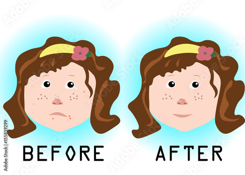 girl with acne problems