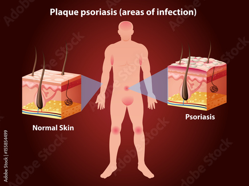 Diagram showing plaque psoriasis in human