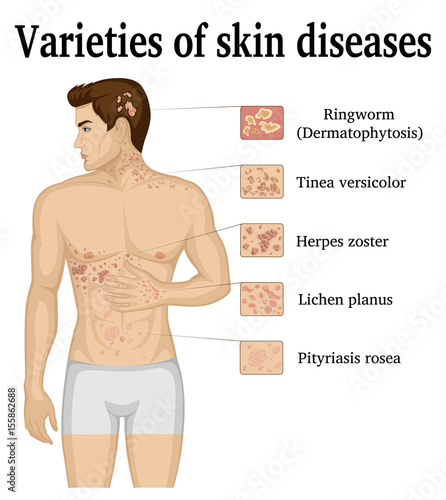 Varieties of skin diseases