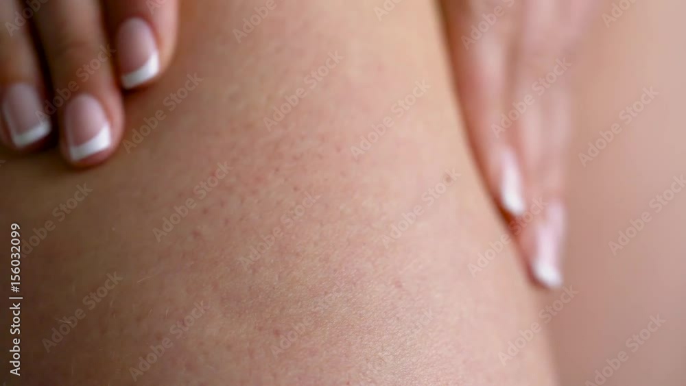Female hip stretch marks on the skin Female hip stretch marks on the skin