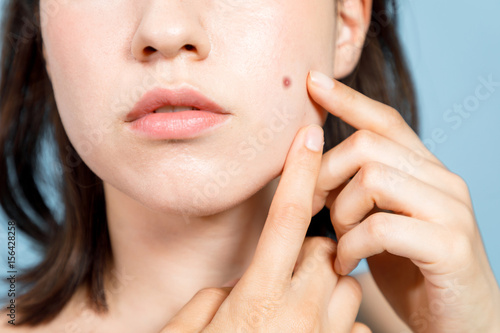 young woman who checks her skin. acne treatment. photo