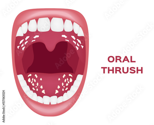 oral thrush vector . white tongue