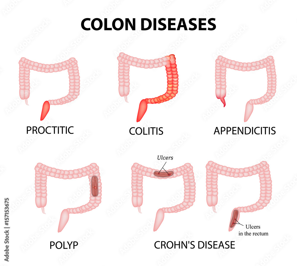 Colon diseases. Proctitis, colitis, appendicitis, polyp, ulcer, Crohn's disease. Infographics
