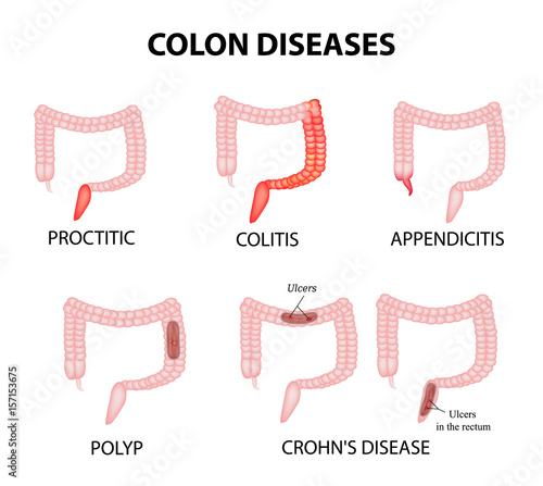 Colon diseases. Proctitis, colitis, appendicitis, polyp, ulcer, Crohn's disease. Infographics. Vector illustration on isolated background