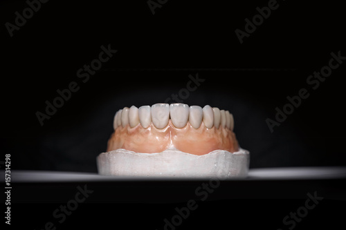 Ceramic teeth dental crowns on model, metal free - front view . Ceramic front veneers isolated on black background. Metal-Ceramic crowns on gypsum model in dental laboratory.