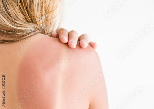Woman's back skin hurt from sun burn. photo
