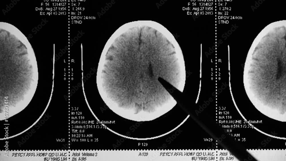 doctor study head pet/ct scan for analysis the disease,skull brain X ...