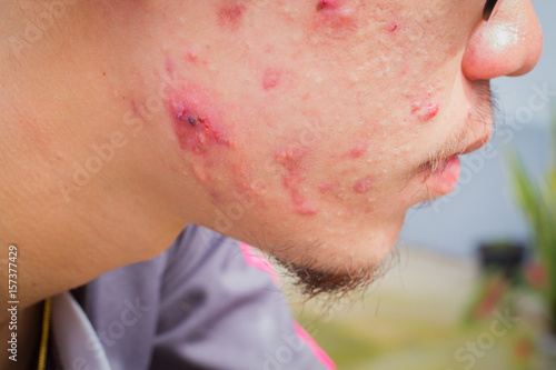 closeup horizontal photo of male cheek with big pimple or acne abcess photo