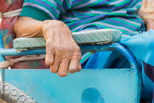 closeup hand of old man suffering from leprosy, amputated hand, on wheelchair photo