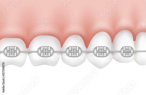 Teeth with metal braces