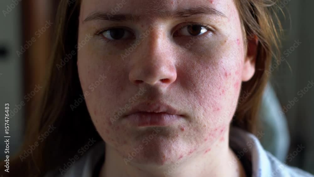 Depressed girl with acne problem Depressed girl with acne problem