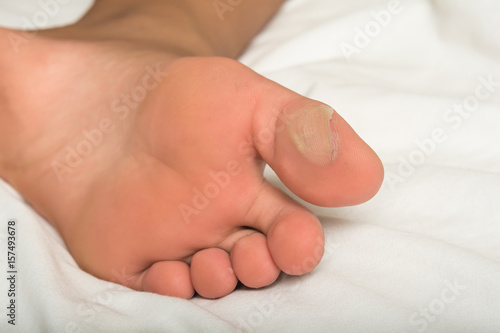 Blisters on the feet