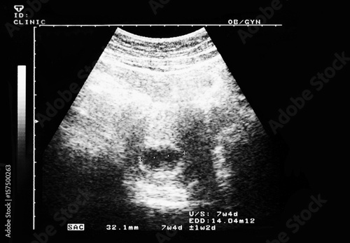 An ultrasound of a human fetus during the 7th week. photo