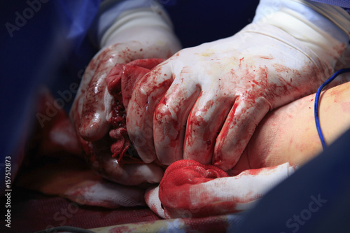 Surgeon hands in bloodstained gloves presses the stump after amputation to stop bleeding close up photo