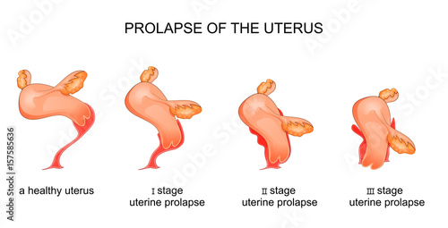 stages of uterine prolapse photo