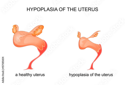 hypoplasia of the uterus photo