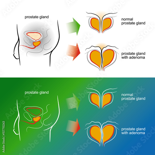 Sketch of a male prostate gland with adenoma. Vector illustration