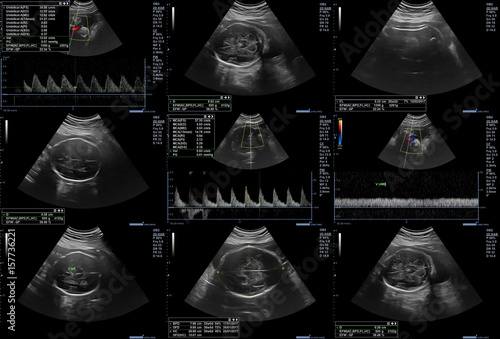 Ultrasonography fetus pictures