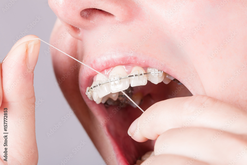 Obraz premium Mund mit Zahnklammer wird mit Zahnseide gereinigt