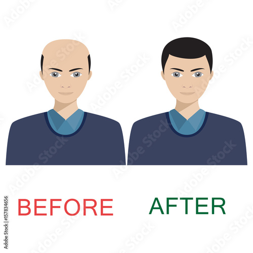 Man before and after hair treatment.