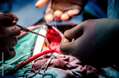 The process of cardiac surgery. The focus is on the medical clamp and suction in the surgeon's arm. A cut is visible in the background.