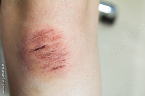 Photography Fresh wound with lymph and blood on asian female knee background