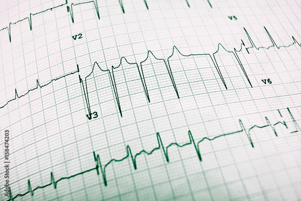 Electrocardiogram Electrocardiogram