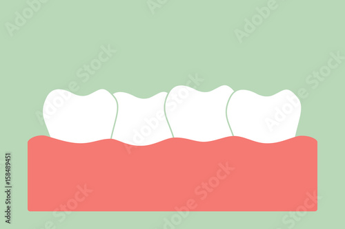 crowding teeth ( malocclusion )