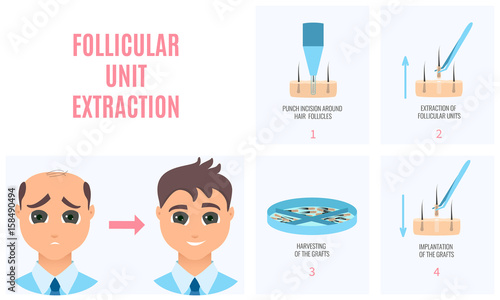 Male hair loss treatment with follicular unit extraction. Stages of FUE procedure. Alopecia infographic medical design template for transplantation clinics and diagnostic centers. Vector illustration.