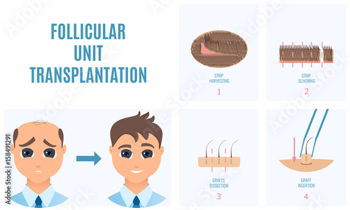 Male hair loss treatment with follicular unit transplantation. Strip method. Stages of FUT procedure. Alopecia medical template. Clinics and diagnostic centers concept design. Vector illustration.